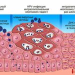 Вирус папилломы человека – как не заболеть и не заразить другого