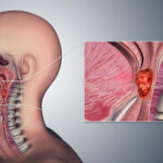Опухоли головы и шеи. Рак гортани.