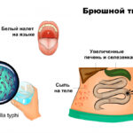 Брюшной тиф
